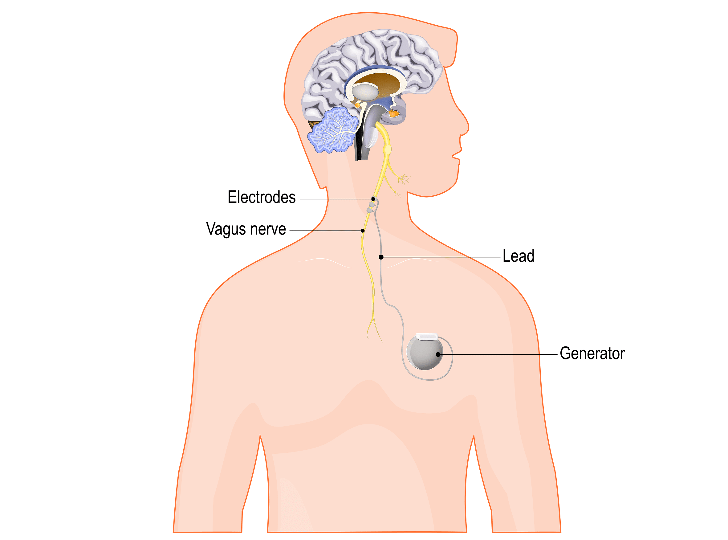 The vagus nerve-stimulation device used for implantation, obtained